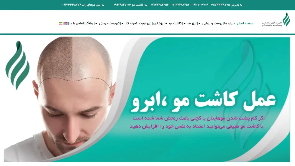 بهترین کاشت مو ارم شیراز