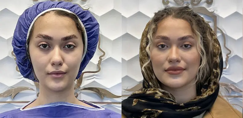 تزریق ژل ماه رز سعادت آباد