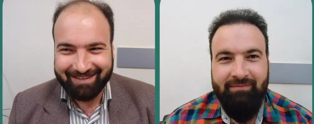 مرکز کاشت مو خسرویانی