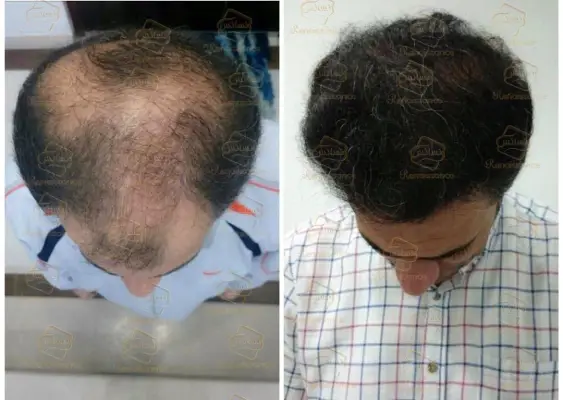 مرکز کاشت مو رنسانس