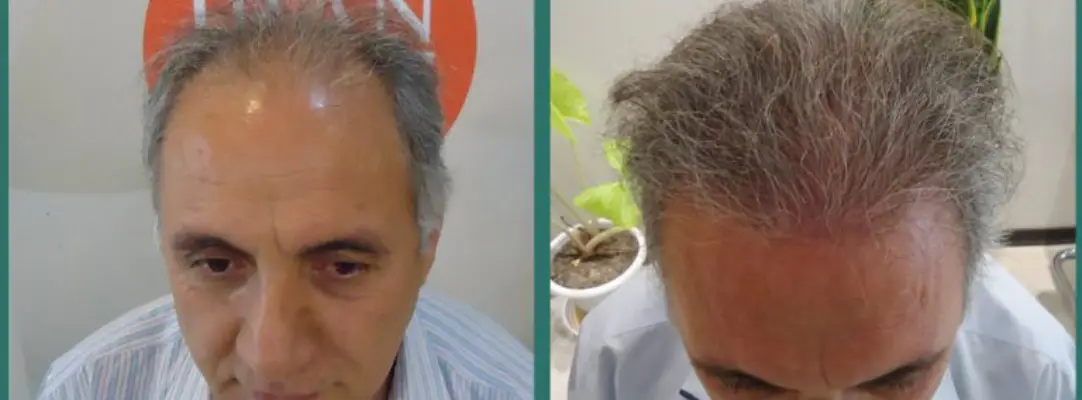 کاشت مو دکتر خسرویانی