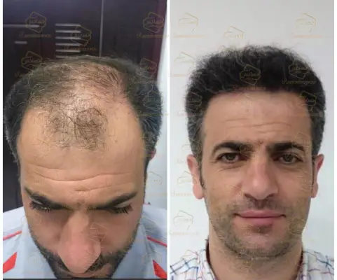 کاشت مو رنسانس سعادت آباد