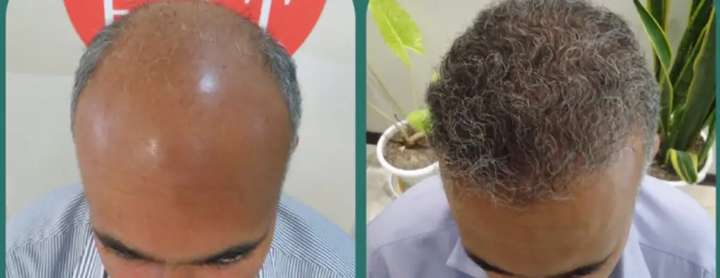 کلینیک کاشت مو خسرویانی