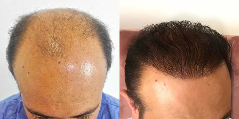 پروتز مو پرنیان نو