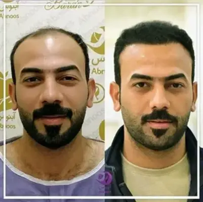 پروتز مو کلینیک زیبایی مولیان