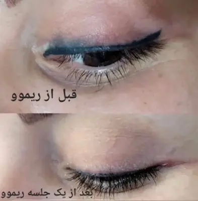 کاشت مو پرنیان نو سعادت آباد